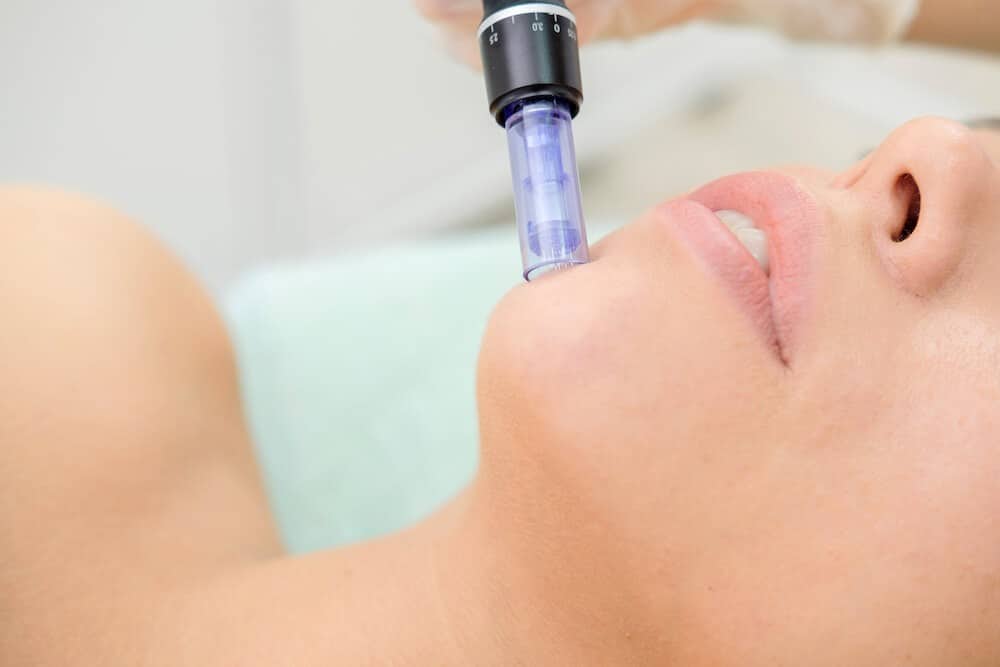 The Benefits Of Microneedling Treatments Colorado Springs