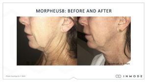 Morpheus8 before and after microneedling Timeless Aesthetics LLC