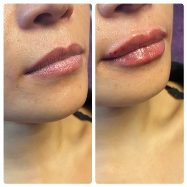 lip fillers near me, lip injections colorado springs