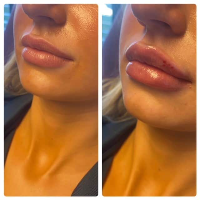 What Are Injectables? - Lip Filler Before and After