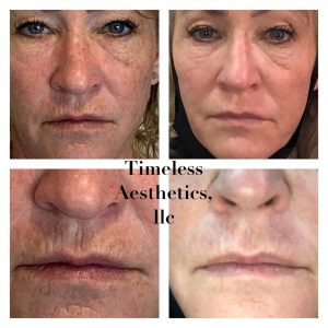 Plasma Pen before and after, Timeless Aesthetics, LLC Colorado Springs