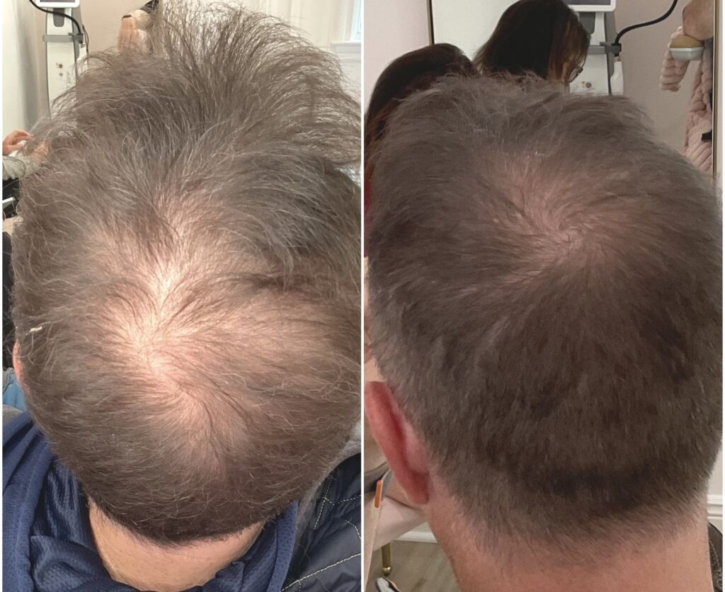 Evo GRO one session 12 weeks apart (1)