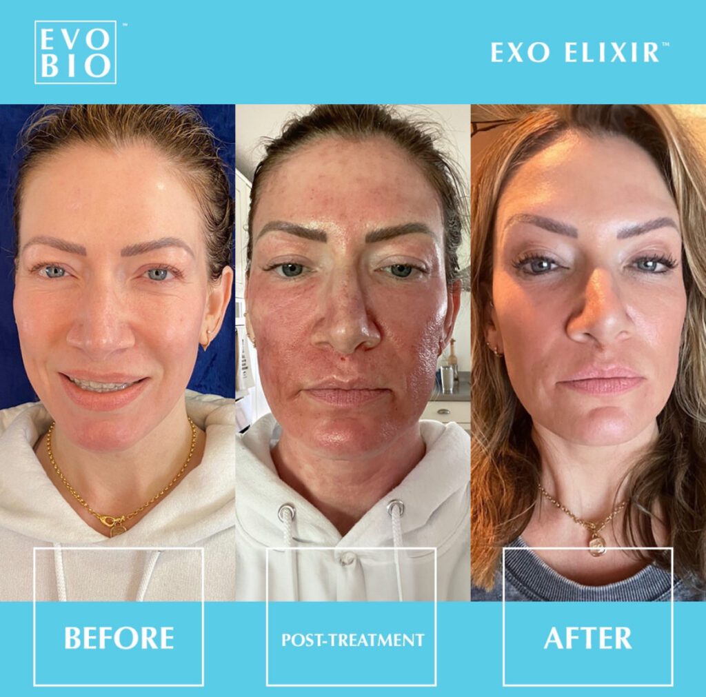 Timeless Aesthetics, LLC | Exosomes vs. PRP: Which Regenerative Treatment is Best for Colorado Springs Skin? Exosomes vs. PRP: Which Regenerative Treatment is Best for Colorado Springs Skin?