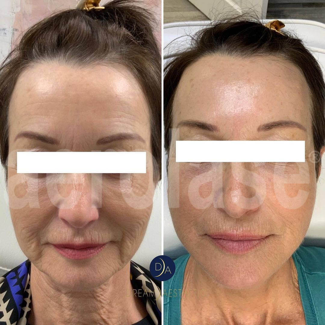 What are the benefits and expected downtime of the Aerolase Era Elite Laser for skin resurfacing? - a before and after picture of a woman with her wrinkles significantly improved due to aerolase treatments