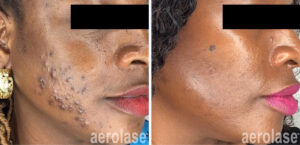 Timeless Aesthetics, LLC | Aerolase® Neo Laser Aerolase Neo laser acne treatment safe for darker skin tones before and after results