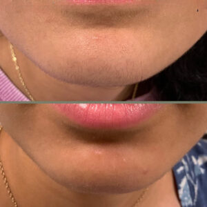 Timeless Aesthetics, LLC | Aerolase® Neo Laser Aerolase Neo laser hair removal treatment for chin and facial hair reduction results