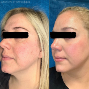 Timeless Aesthetics, LLC | Aerolase® Neo Laser Aerolase Neo skin rejuvenation treatment improving tone, texture, and glow before and after