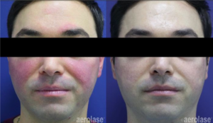 Timeless Aesthetics, LLC | Reverse by Aerolase (Neo + Era) in Colorado Springs Before and after Reverse by Aerolase treatment showing reduced rosacea and facial redness in Colorado Springs