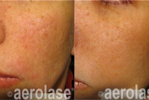 Timeless Aesthetics, LLC | Reverse by Aerolase (Neo + Era) in Colorado Springs Before and after Reverse by Aerolase laser treatment improving acne, redness, and uneven skin texture