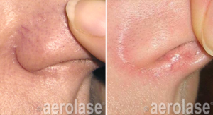 Timeless Aesthetics, LLC | Aerolase® Neo Laser Aerolase Neo laser treatment for spider veins on nose before and after in Colorado Springs