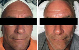 Timeless Aesthetics, LLC | Reverse by Aerolase (Neo + Era) in Colorado Springs Before and after Reverse by Aerolase treatment showing smoother skin texture and reduced fine lines on the forehead