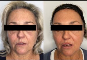 Timeless Aesthetics, LLC | Reverse by Aerolase (Neo + Era) in Colorado Springs Before and after dual laser skin rejuvenation with Reverse by Aerolase improving pigmentation, fine lines, and skin texture