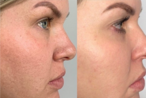 Timeless Aesthetics, LLC | Reverse by Aerolase (Neo + Era) in Colorado Springs Before and after Reverse by Aerolase laser treatment showing smoother skin texture and more even skin tone
