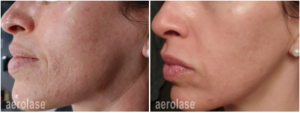 Timeless Aesthetics, LLC | Reverse by Aerolase (Neo + Era) in Colorado Springs Before and after Reverse by Aerolase treatment improving acne, scarring, and uneven skin texture in Colorado Springs