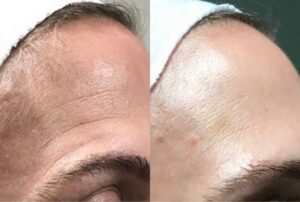 Timeless Aesthetics, LLC | Reverse by Aerolase (Neo + Era) in Colorado Springs Before and after dual laser skin rejuvenation with Reverse by Aerolase showing improved skin tone and smoother texture