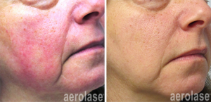 Timeless Aesthetics, LLC | Aerolase® Neo Laser Aerolase Neo laser treatment for rosacea and facial redness before and after results Colorado Springs