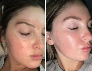Timeless Aesthetics, LLC | Aerolase® Neo Laser Aerolase Neo laser treatment for melasma and pigmentation before and after multiple sessions