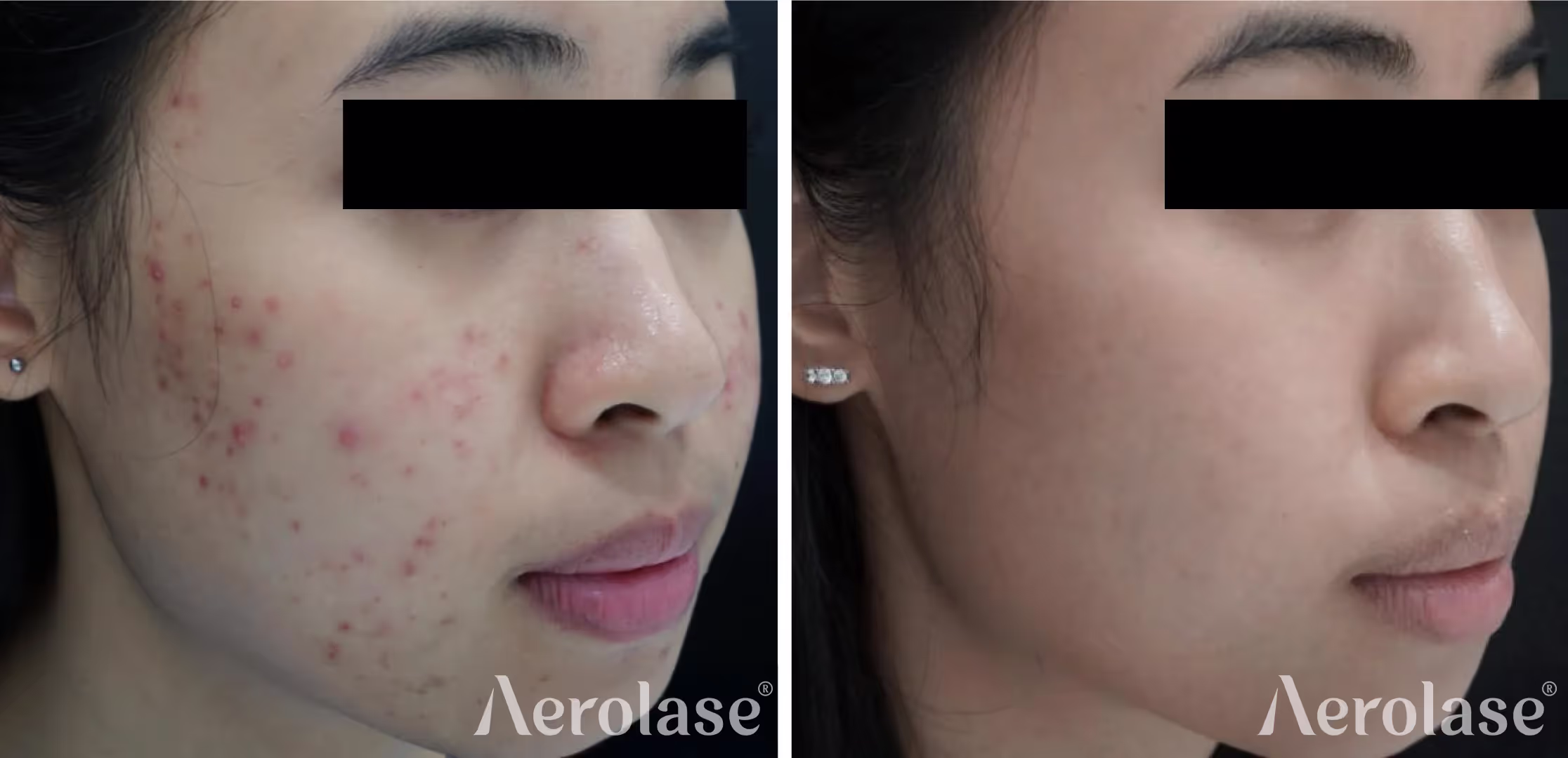 Aerolase Neo Colorado Springs