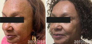 Colorado Springs sun damage treatments aerolase reverse