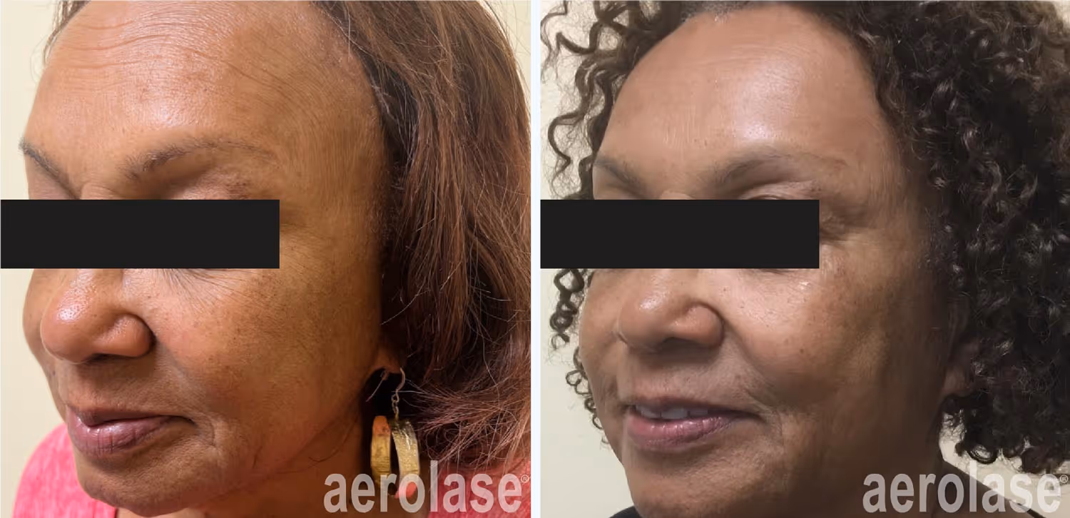 Colorado Springs sun damage treatments aerolase reverse